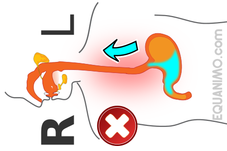 Acid Reflux - What should I know and do? | EQUANIMO